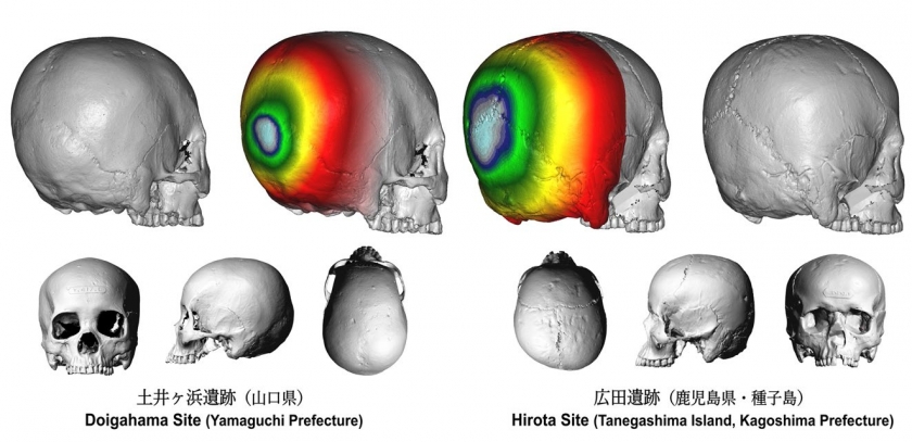 種子島の広田遺跡における古代の人為的な頭蓋変形習慣を解明する画期的